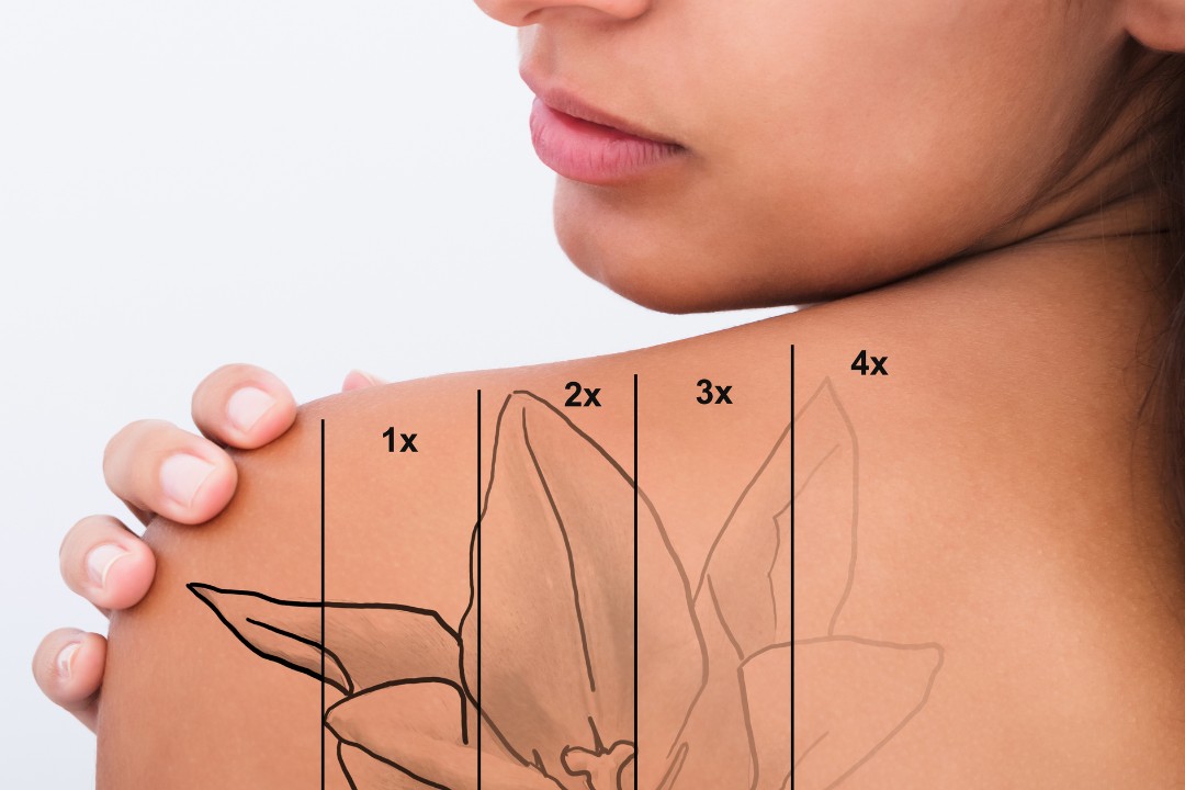 consigli-rimozione-tatuaggi-sicura-efficace-inmode