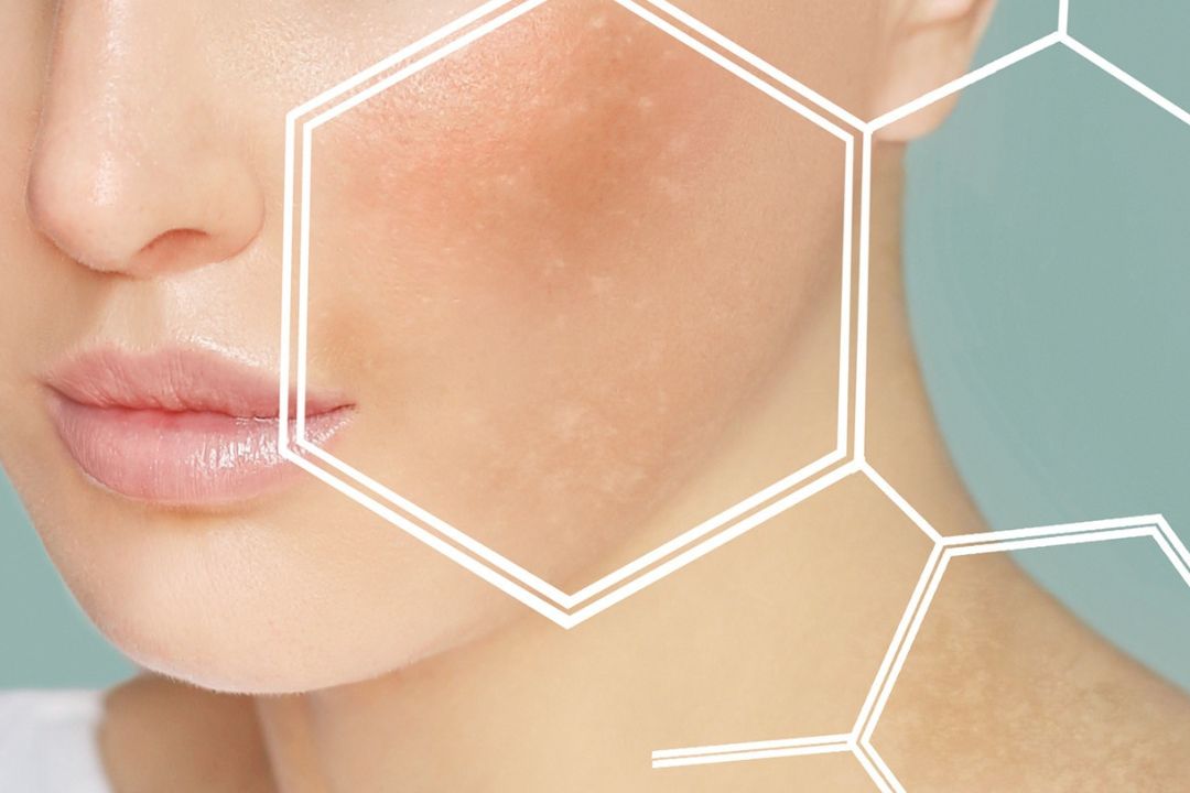 Macchie Solari sul viso: Cosa sono, come prevenirle e trattarle